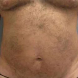 Smartlipo Vaser Lipo Before & After Patient #544