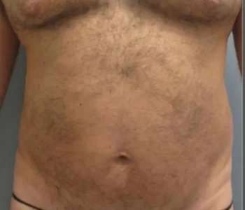 Smartlipo Vaser Lipo Before & After Patient #544