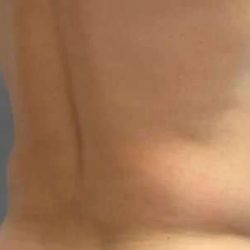 Smartlipo Vaser Lipo Before & After Patient #547