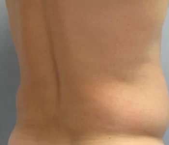 Smartlipo Vaser Lipo Before & After Patient #547