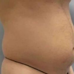 Smartlipo Vaser Lipo Before & After Patient #550