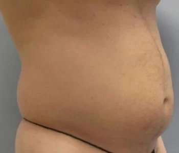Smartlipo Vaser Lipo Before & After Patient #550