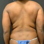 Smartlipo Vaser Lipo Before & After Patient #553