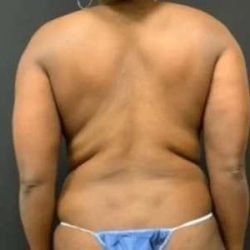 Smartlipo Vaser Lipo Before & After Patient #553