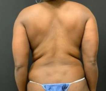 Smartlipo Vaser Lipo Before & After Patient #553
