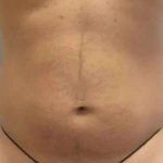 Smartlipo Vaser Lipo Before & After Patient #556