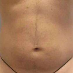 Smartlipo Vaser Lipo Before & After Patient #556