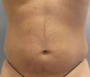 Smartlipo Vaser Lipo Before & After Patient #556