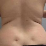 Smartlipo Vaser Lipo Before & After Patient #561