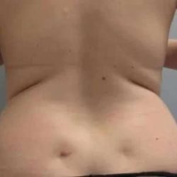 Smartlipo Vaser Lipo Before & After Patient #561