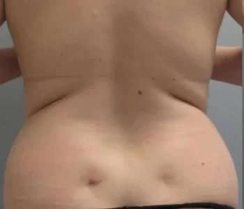 Smartlipo Vaser Lipo Before & After Patient #561