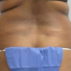 Smartlipo Vaser Lipo Before & After Patient #570