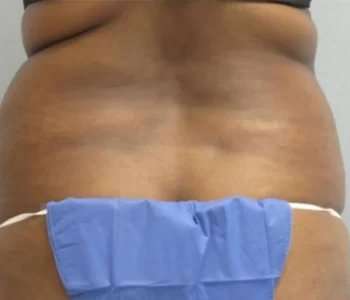 Smartlipo Vaser Lipo Before & After Patient #570