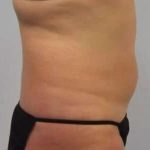 Smartlipo Vaser Lipo Before & After Patient #573