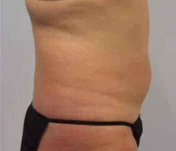 Smartlipo Vaser Lipo Before & After Patient #573