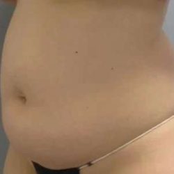 Smartlipo Vaser Lipo Before & After Patient #576