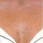 Fractional CO2 Laser Before & After Patient #116