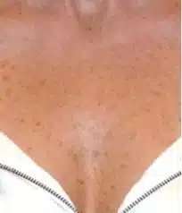 Fractional CO2 Laser Before & After Patient #116