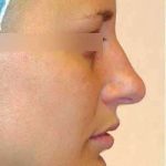 Rhinoplasty Before & After Patient #69