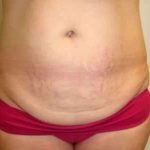 Smartlipo Vaser Lipo Before & After Patient #582
