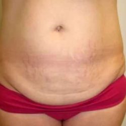 Smartlipo Vaser Lipo Before & After Patient #582