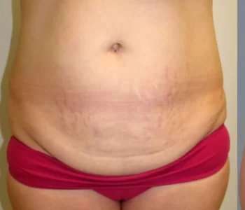 Smartlipo Vaser Lipo Before & After Patient #582