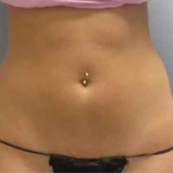Smartlipo Vaser Lipo Before & After Patient #587
