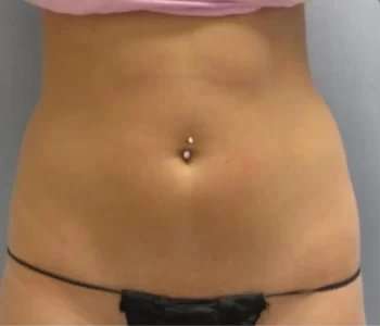 Smartlipo Vaser Lipo Before & After Patient #587