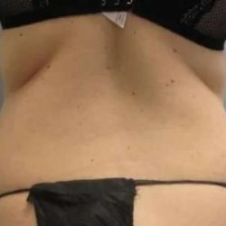Smartlipo Vaser Lipo Before & After Patient #590