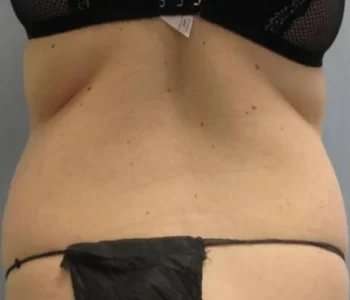 Smartlipo Vaser Lipo Before & After Patient #590