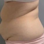 Smartlipo Vaser Lipo Before & After Patient #593