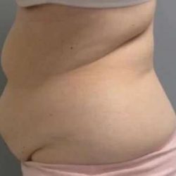 Smartlipo Vaser Lipo Before & After Patient #593
