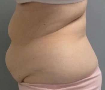 Smartlipo Vaser Lipo Before & After Patient #593