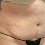 Smartlipo Vaser Lipo Before & After Patient #596