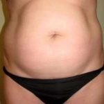 Smartlipo Vaser Lipo Before & After Patient #602