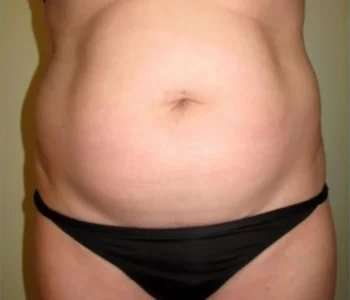 Smartlipo Vaser Lipo Before & After Patient #602