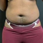 Smartlipo Vaser Lipo Before & After Patient #605