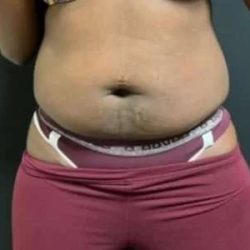 Smartlipo Vaser Lipo Before & After Patient #605
