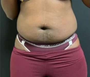 Smartlipo Vaser Lipo Before & After Patient #605