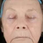 Fractional CO2 Laser Before & After Patient #119