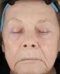 Fractional CO2 Laser Before & After Patient #119