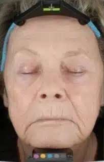 Fractional CO2 Laser Before & After Patient #119