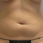 Smartlipo Vaser Lipo Before & After Patient #611