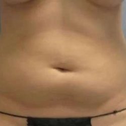 Smartlipo Vaser Lipo Before & After Patient #611