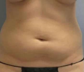 Smartlipo Vaser Lipo Before & After Patient #611