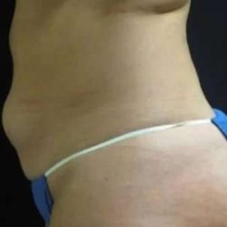 Smartlipo Vaser Lipo Before & After Patient #614