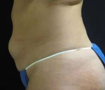 Smartlipo Vaser Lipo Before & After Patient #614