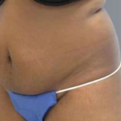 Smartlipo Vaser Lipo Before & After Patient #617
