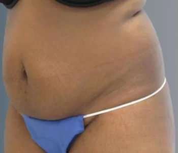 Smartlipo Vaser Lipo Before & After Patient #617