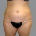 Smartlipo Vaser Lipo Before & After Patient #624